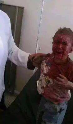 Le martyre de cet enfant yéménite victime des bombardements de vendredi n'intéressera pas les médiats, ne pouvant exploiter cette souffrance contre l'Europe.